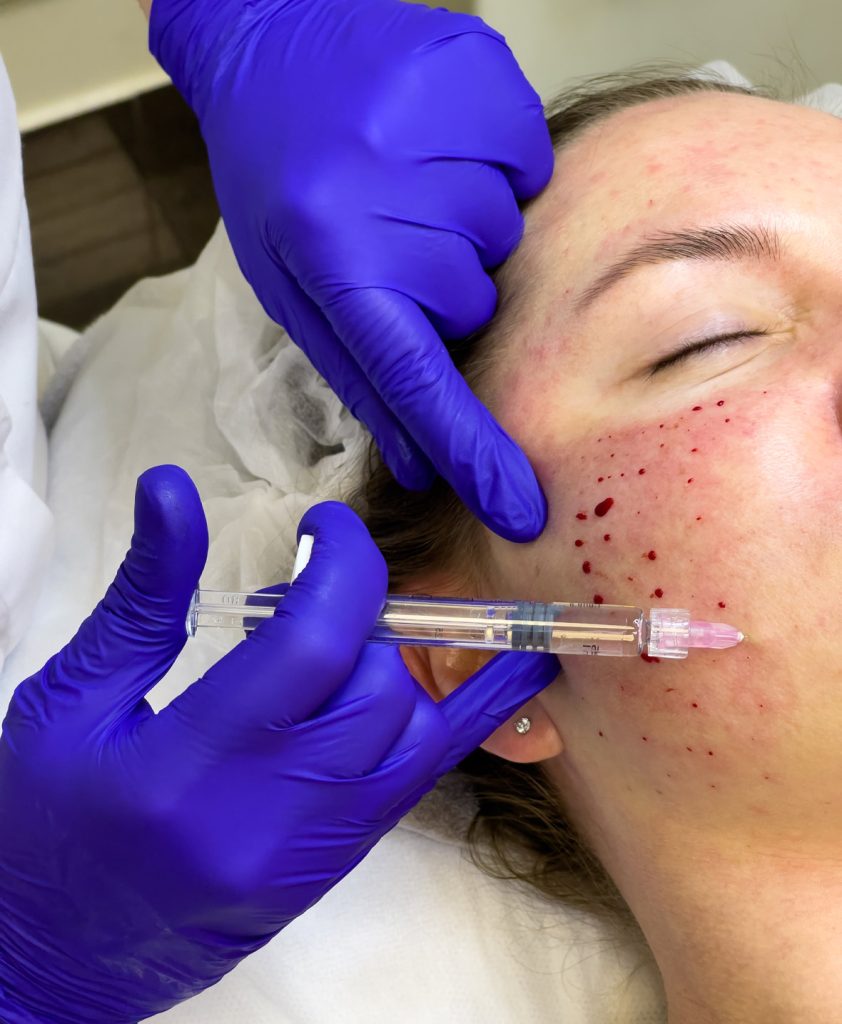 Close-up of dermatologist performing acne injection treatment on woman's cheek to reduce inflammation and acne breakouts