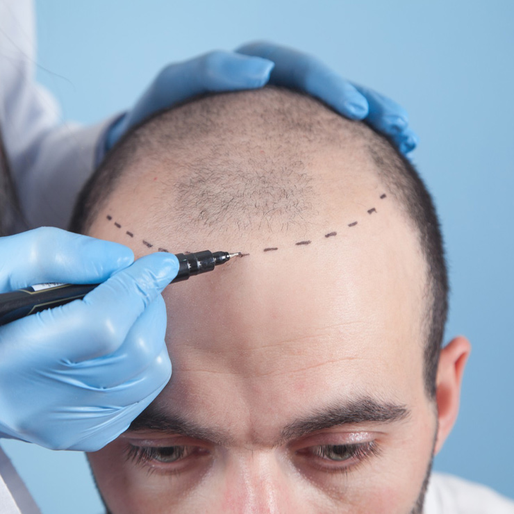 hair grafting procedure for hair restoration treatment