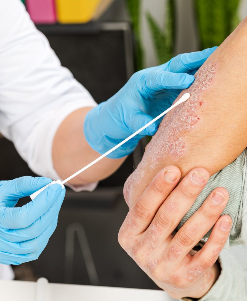 Doctor examining skin with white patches on patient's back, possible vitiligo.