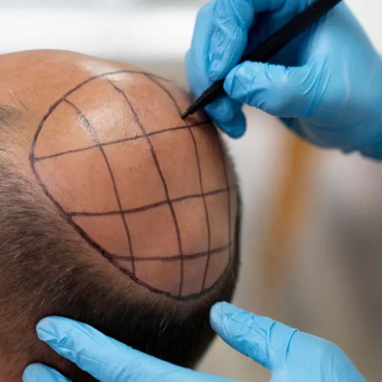 Doctor marking grid lines on a man's scalp during a hair loss treatment assessment.